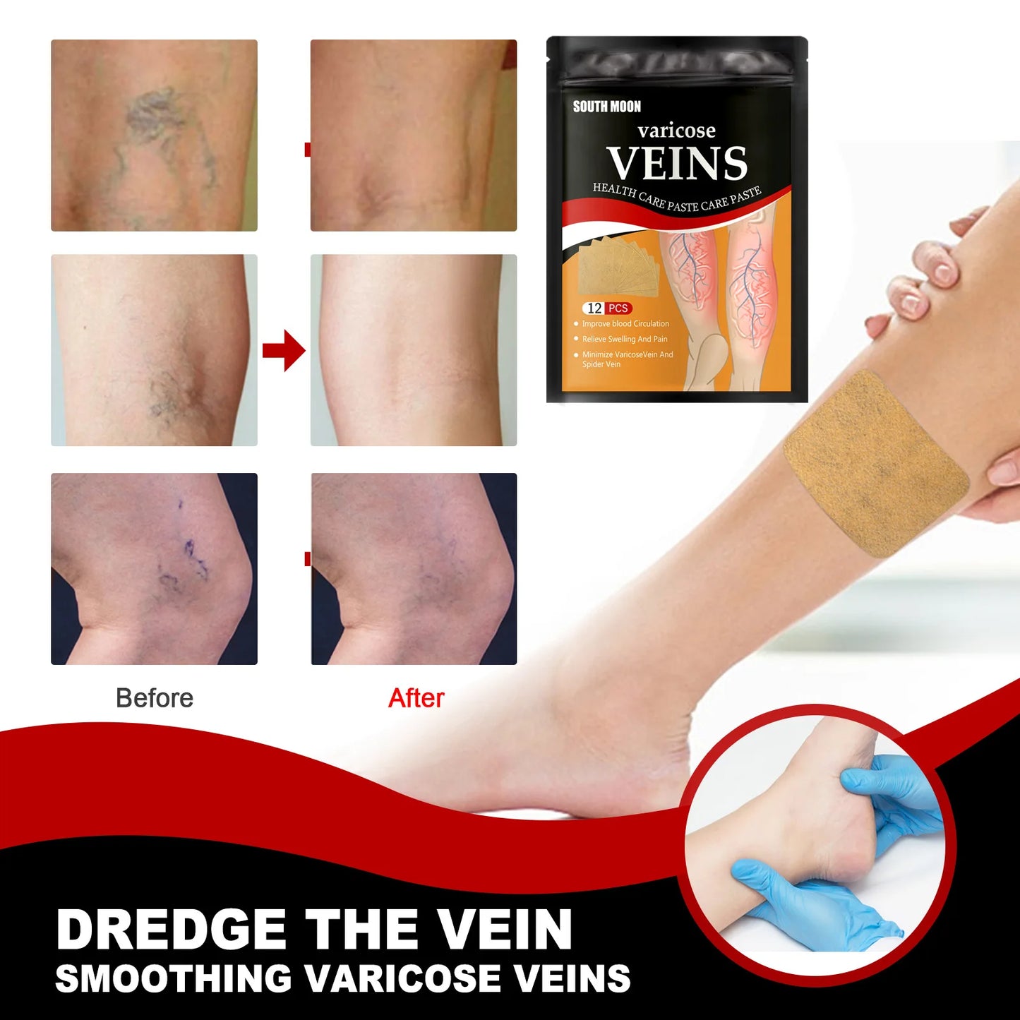 Varicose Veins Patch Treatment For Varicose Veins Vasculitis Phlebitis Spider Leg Medical Patch Angiitis Removal Patch